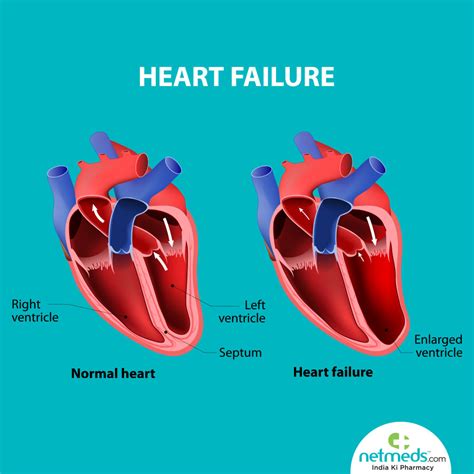 what is severe Lv dysfunction